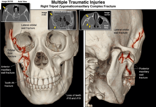 A severe head injury that resulted from a serious auto accident.